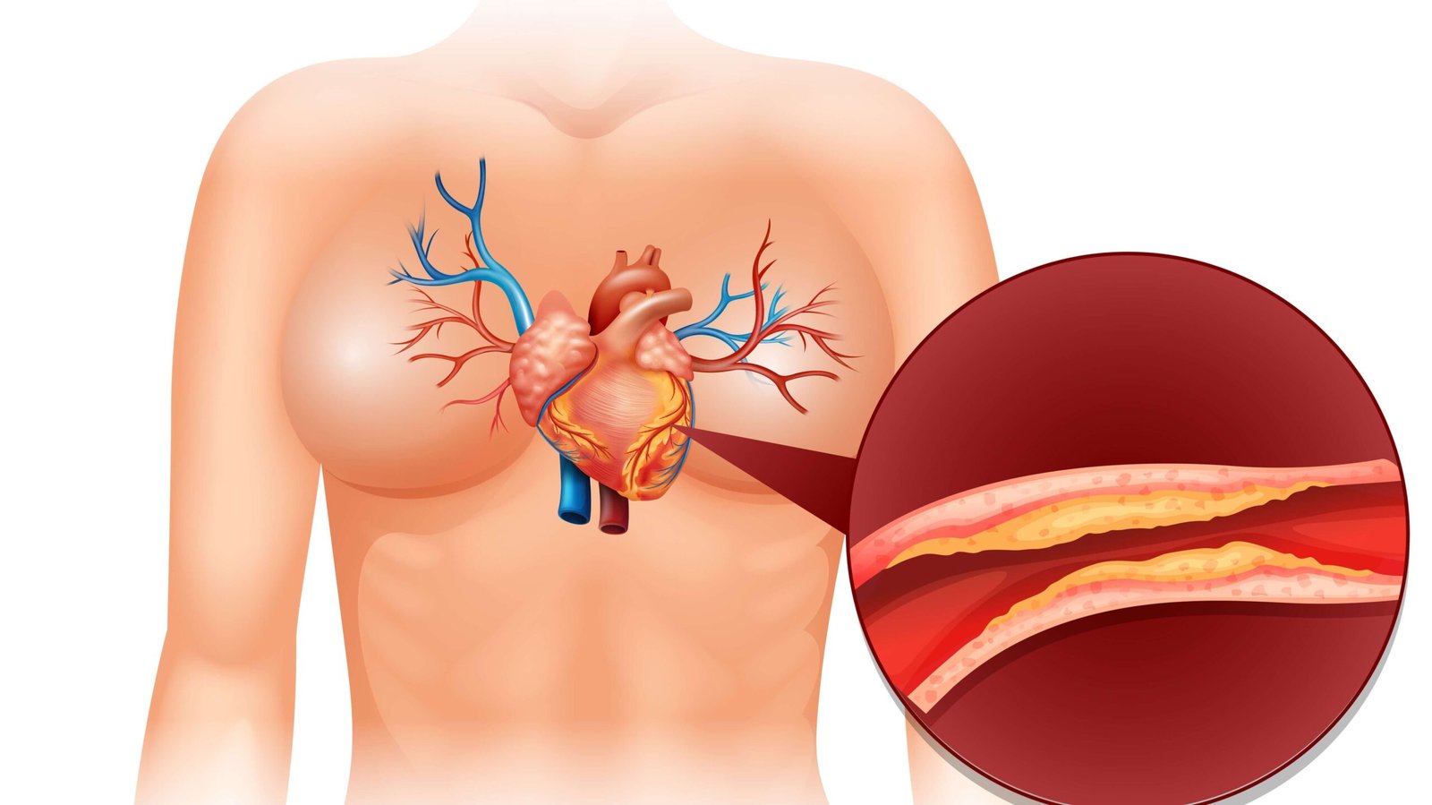 Coronary artery disease