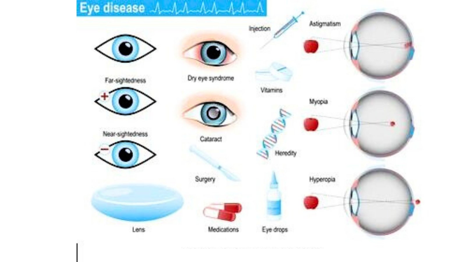 Common Eye Diseases