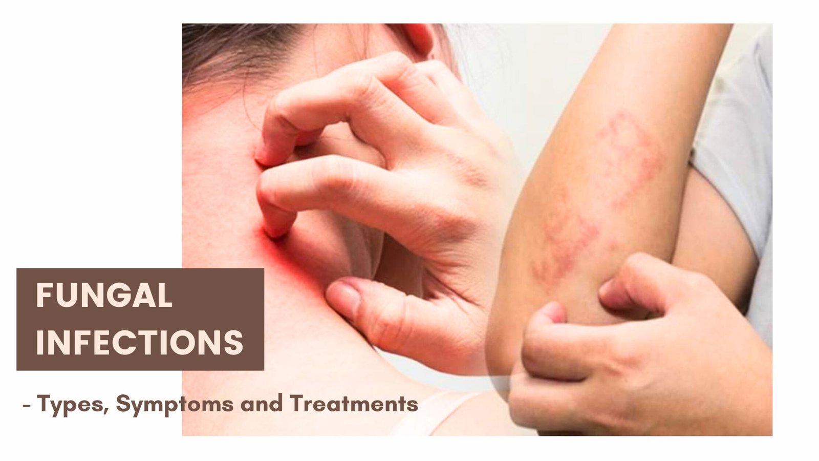 Fungal skin infections