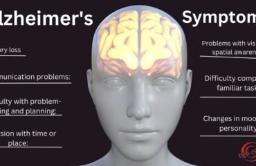 Alzheimer's disease: Cause, Symptoms, Treatment & Prevention