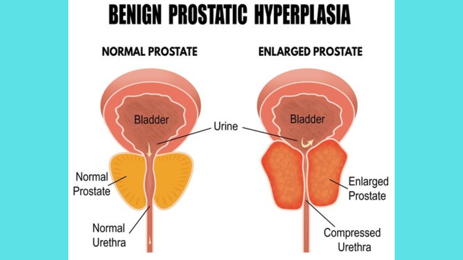 Benign prostatic hyperplasia